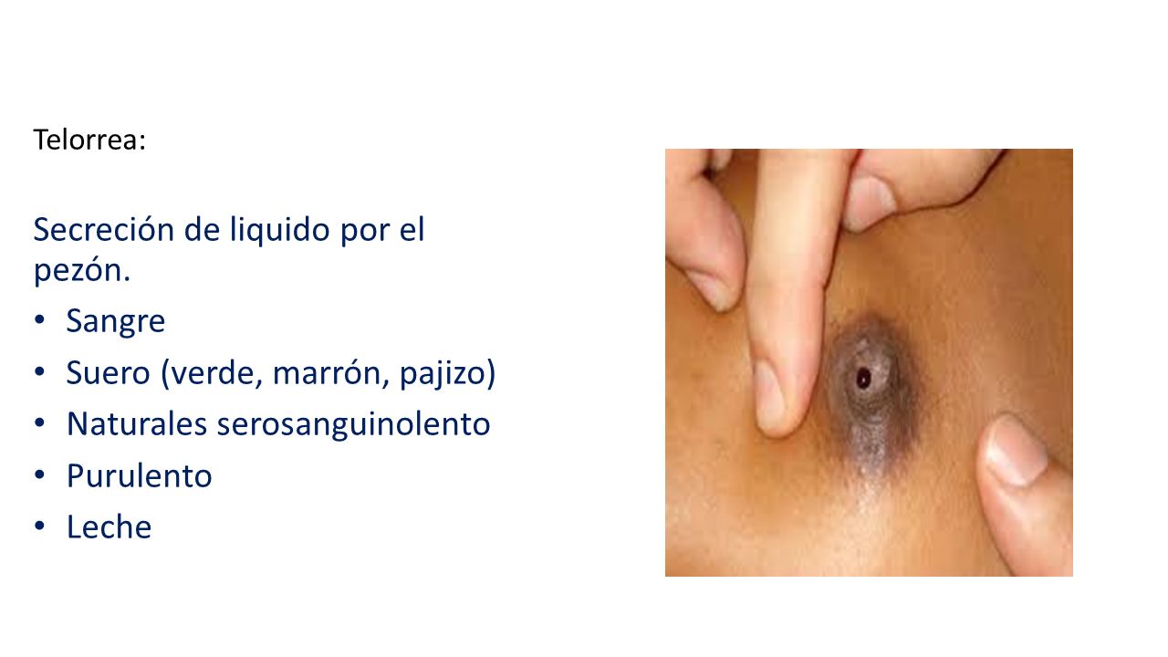 En el pezon sangre